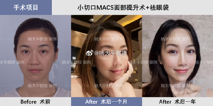 楊大平面部提升案例