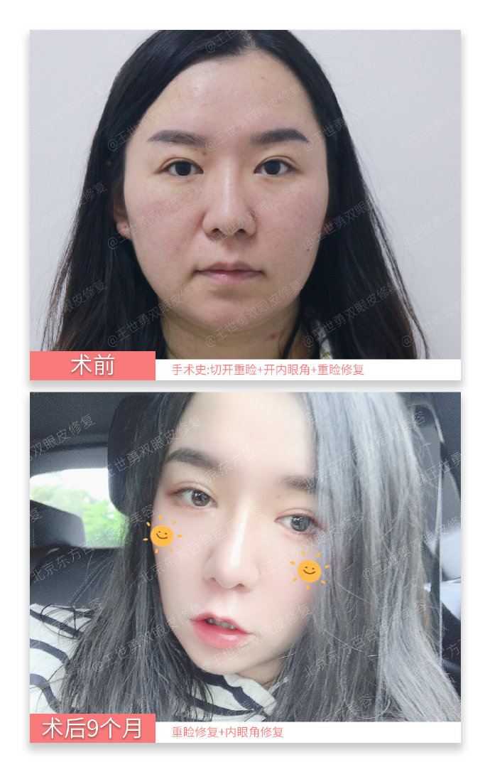 王世勇雙眼皮修復(fù)案例