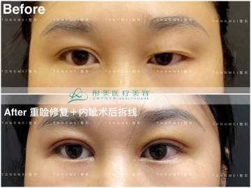 北京劉風(fēng)卓、白永輝和王世勇誰修復(fù)雙眼皮最好呢