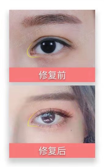 王世勇內(nèi)眼角修復案例