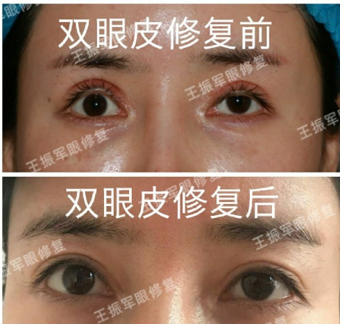 王振軍眼角修復案例