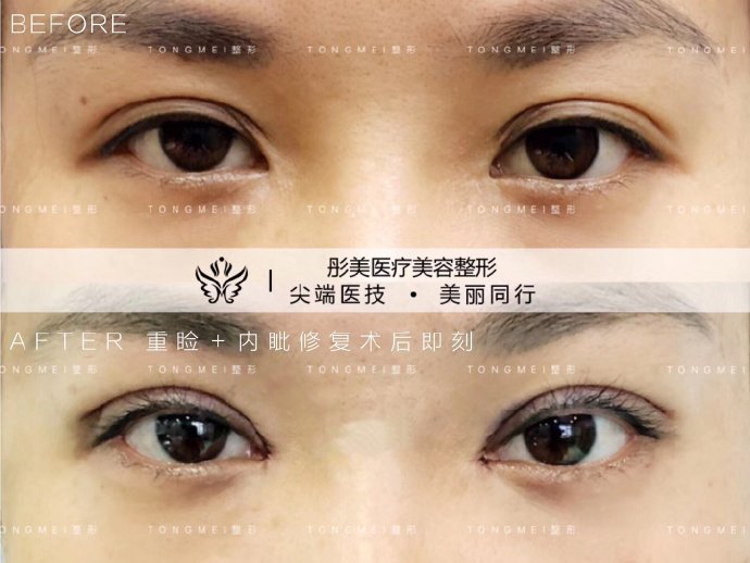 劉風卓眼角修復案例