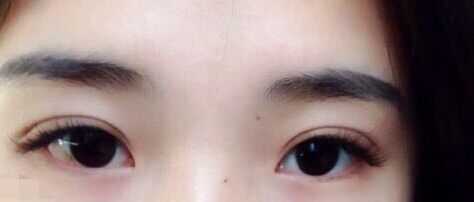 朱惠敏雙眼皮案例