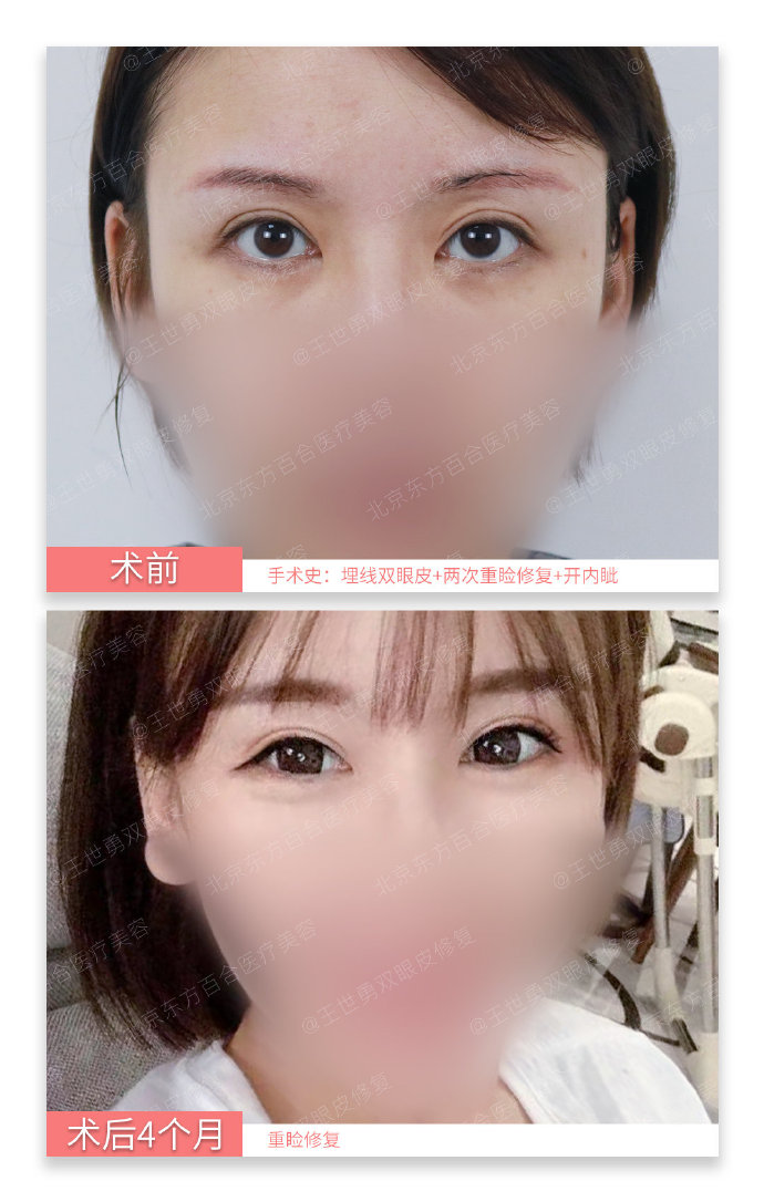 王世勇雙眼皮修復案例