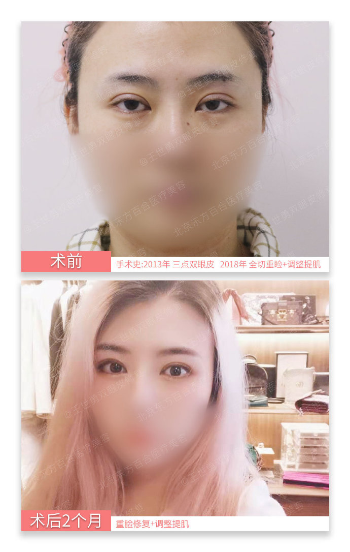 王世勇雙眼皮修復案例