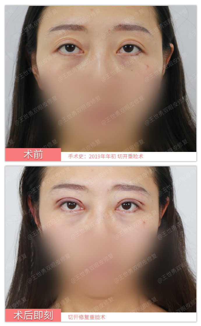 王世勇雙眼皮修復案例