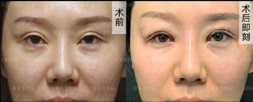 鄭永生雙眼皮修復案例