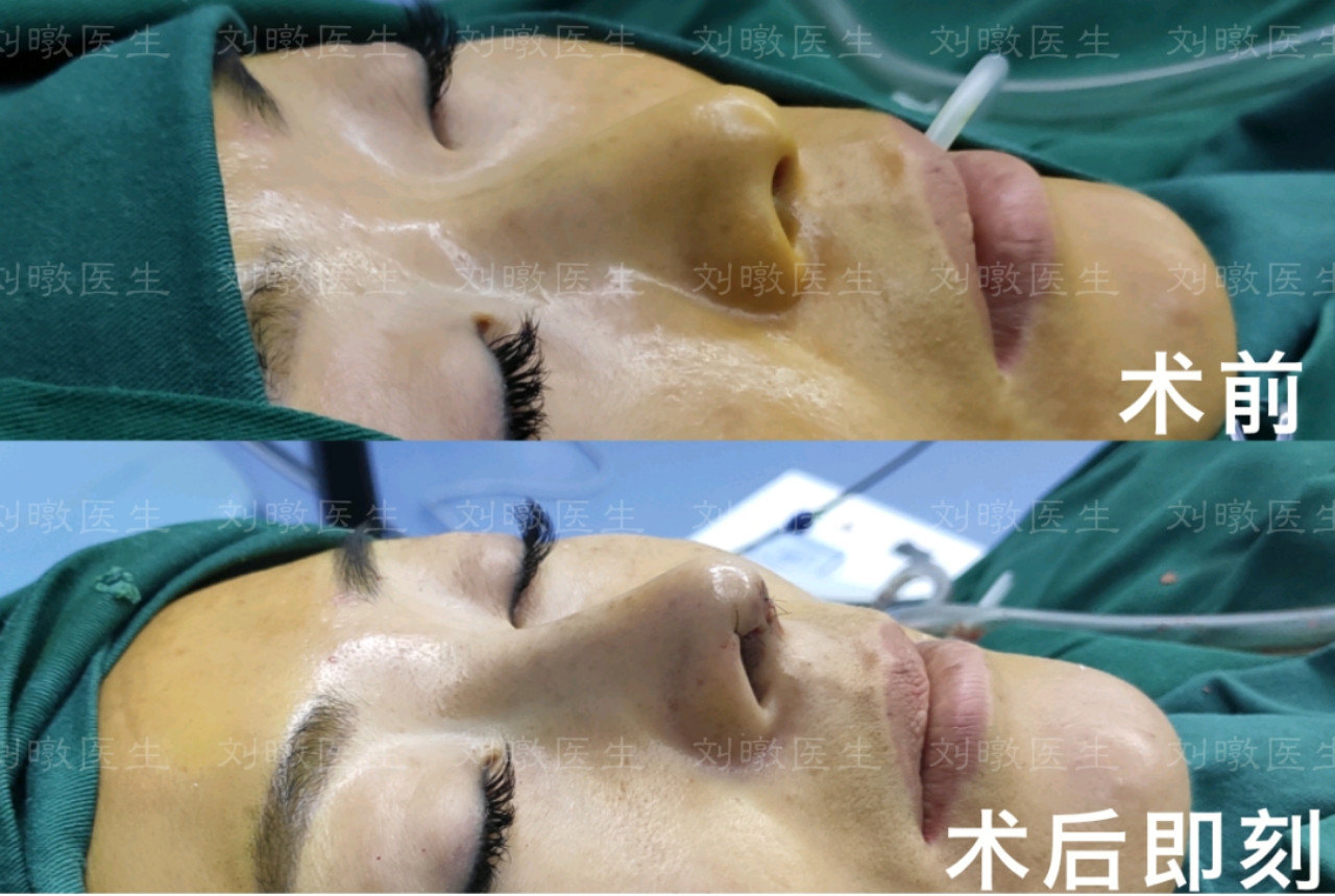 劉暾鼻子案例