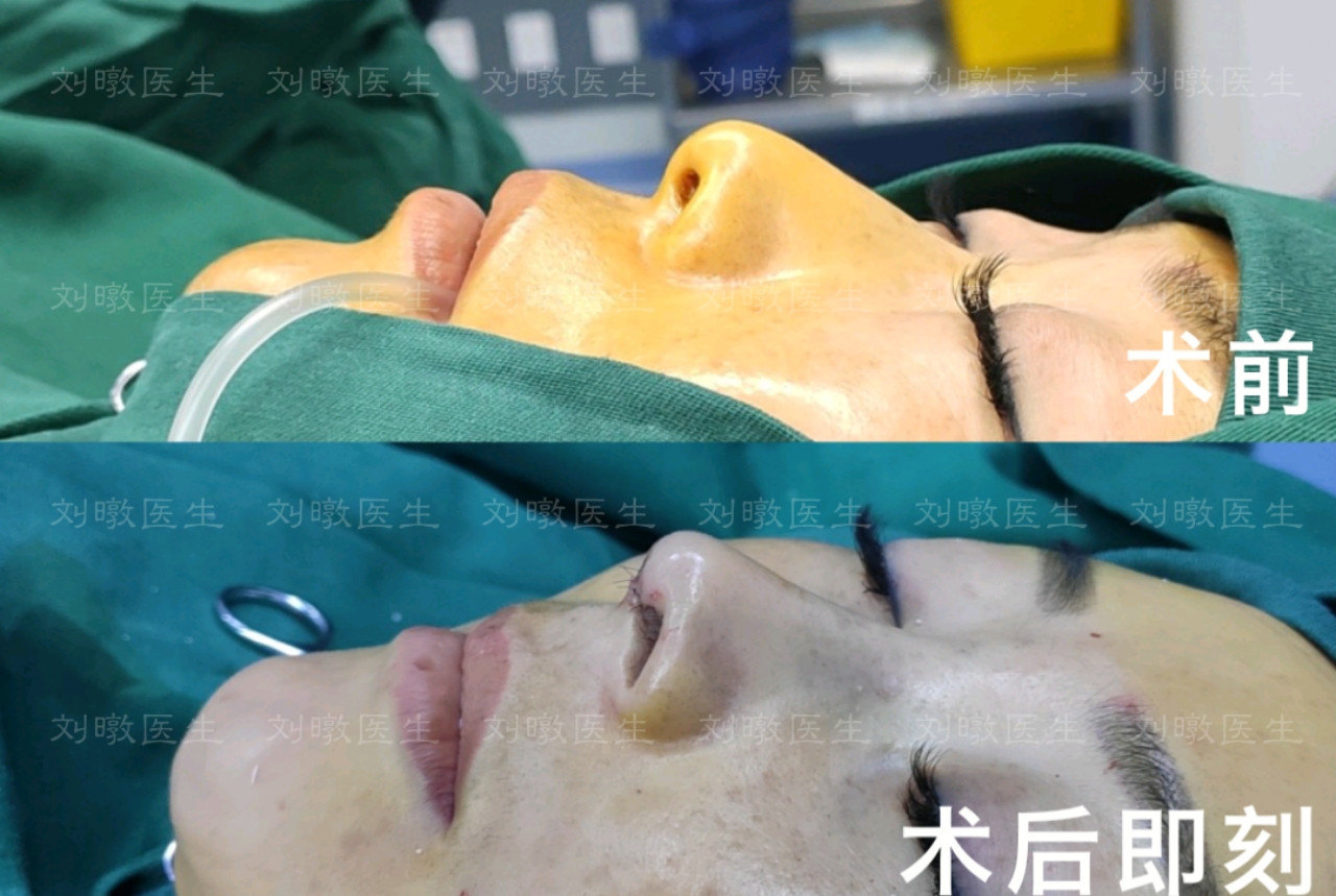 劉暾鼻子案例