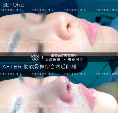 李長賦鼻綜合案例