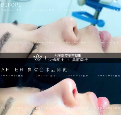 李長賦鼻綜合案例