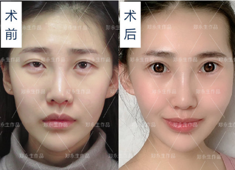 鄭永生眼修復案例