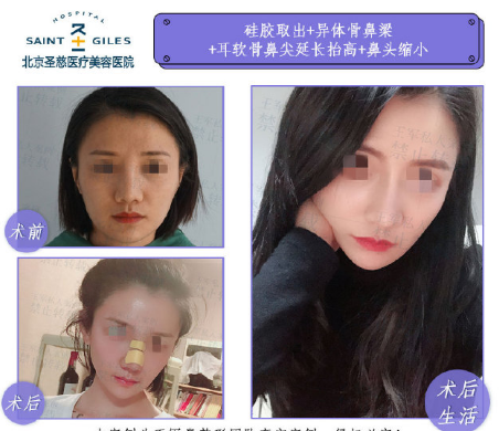 王軍隆鼻案例
