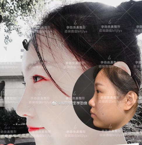 李勁良隆鼻案例