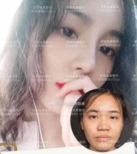 李勁良隆鼻案例