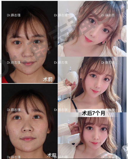 薛志強肋骨鼻案例