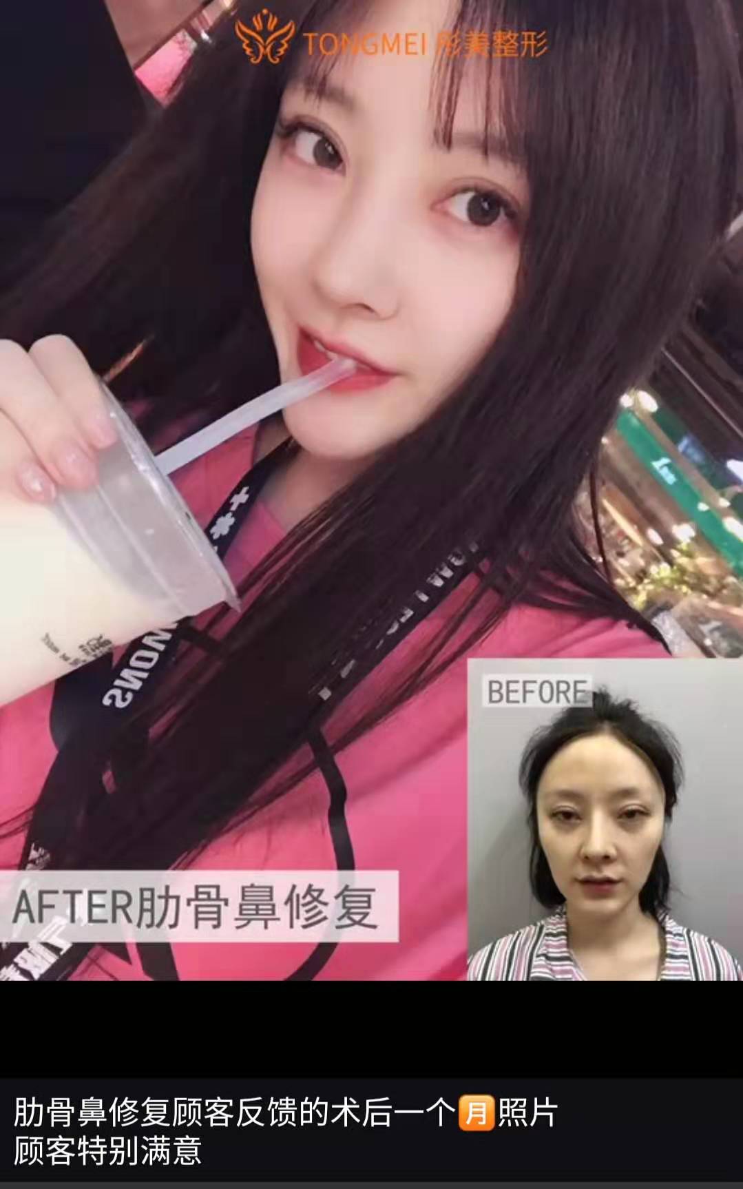 李長賦肋骨鼻案例
