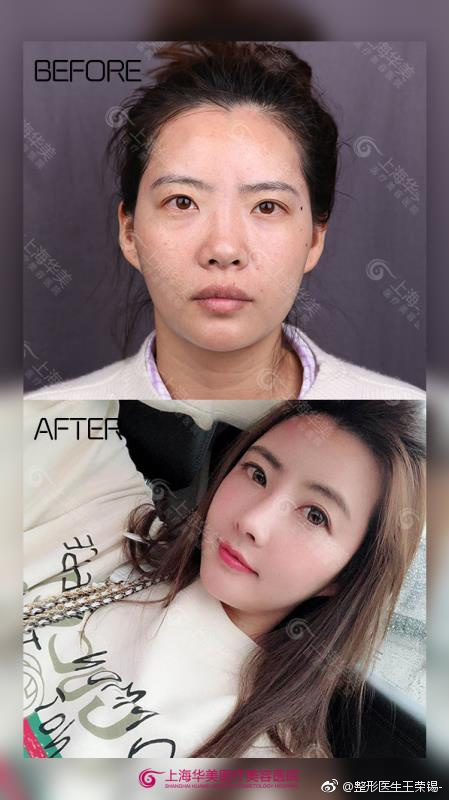 王榮錫面部填充