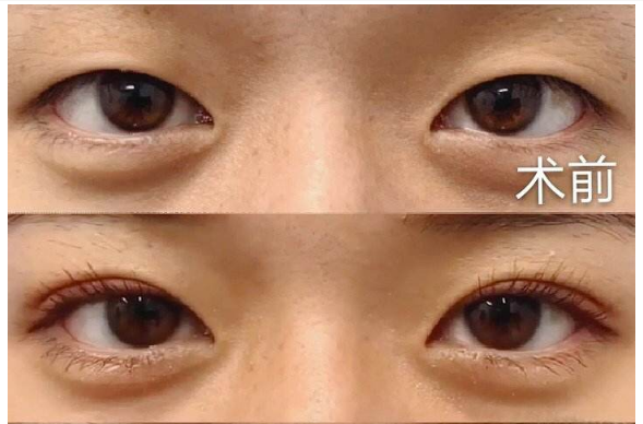 北京做雙眼皮最好的專家是誰？