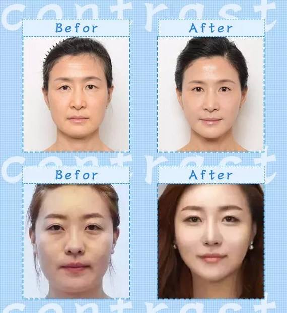 全臉提升什么效果最好?全臉提升多少錢一次?