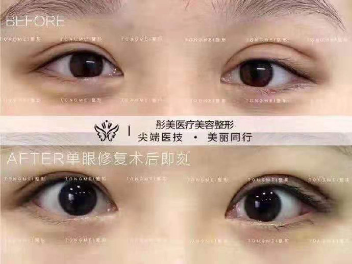劉風卓雙眼皮修復案例