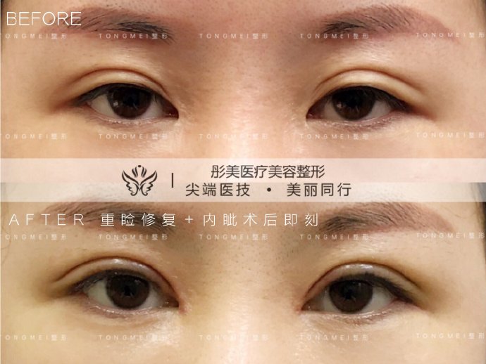 劉風卓眼修復案例