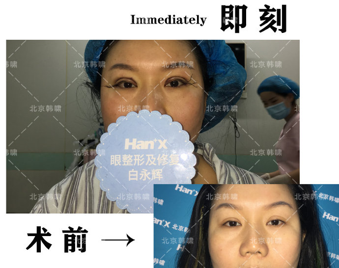 白永輝雙眼皮修復案例