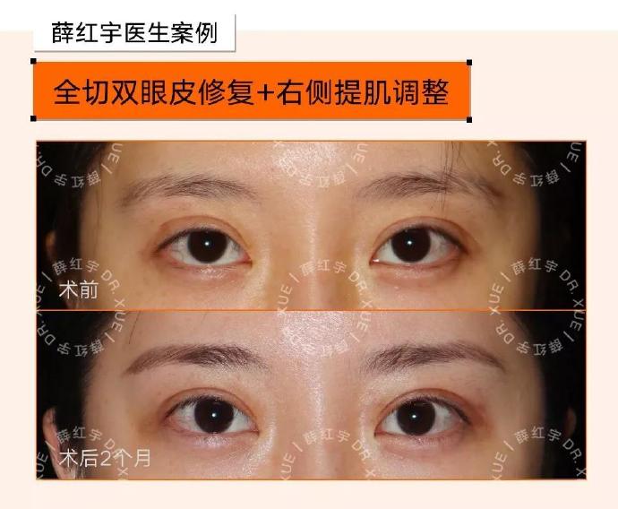 薛紅宇雙眼皮修復案例