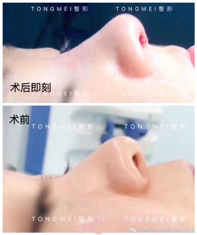 李長賦鼻綜合案例