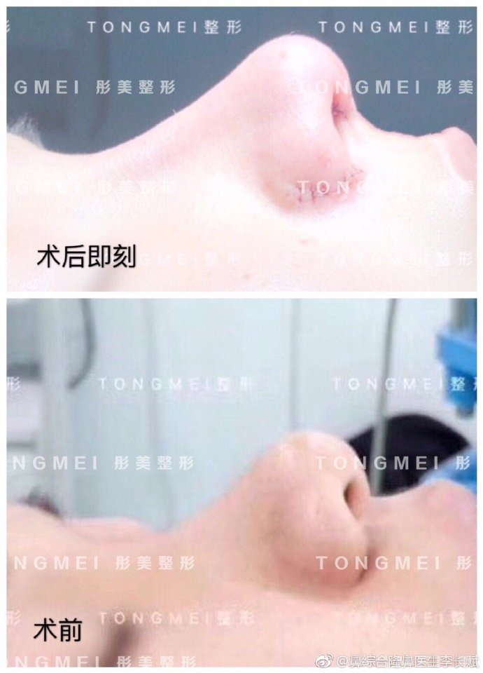李長賦鼻綜合案例