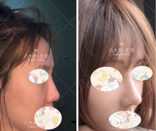 王歡鼻綜合案例