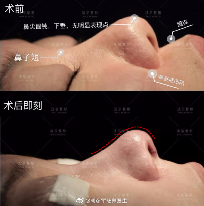 劉彥軍鼻綜合案例