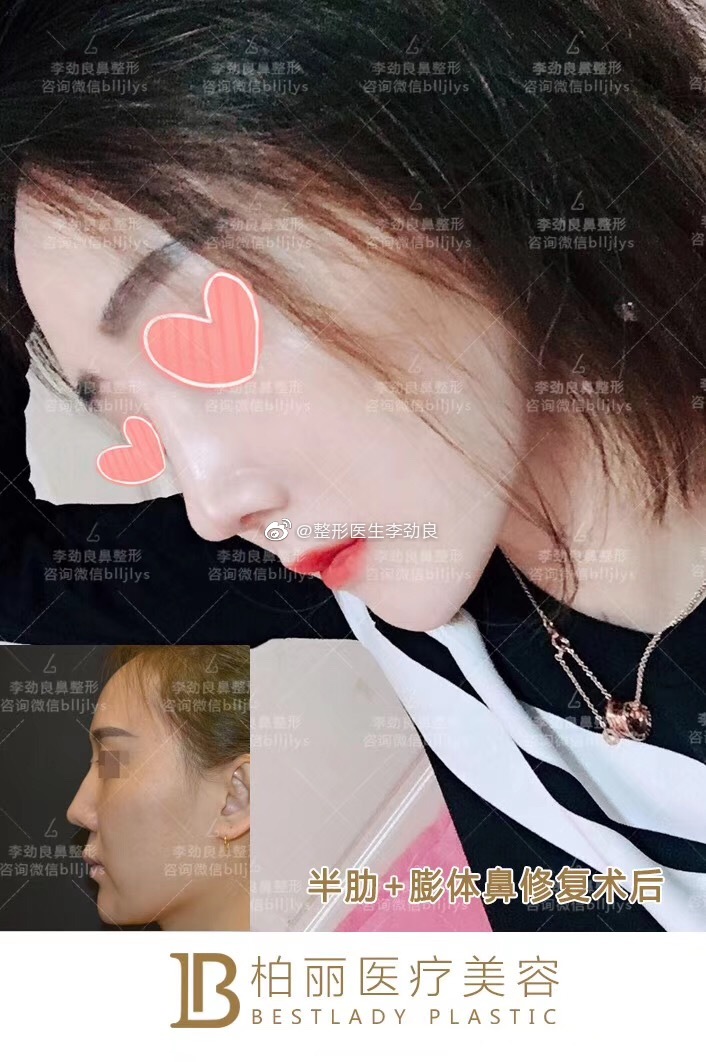 李勁良鼻修復(fù)案例