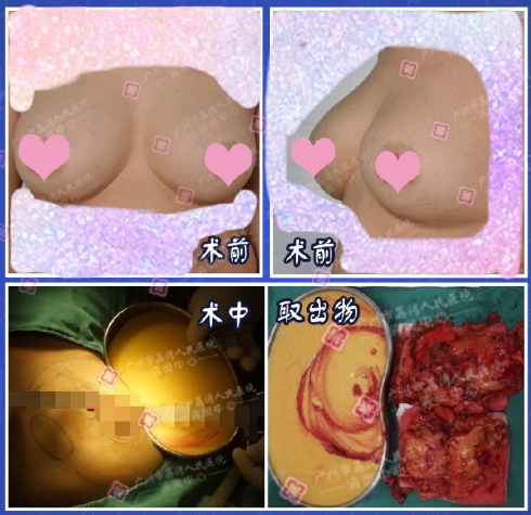鄧正軍奧美定取出案例