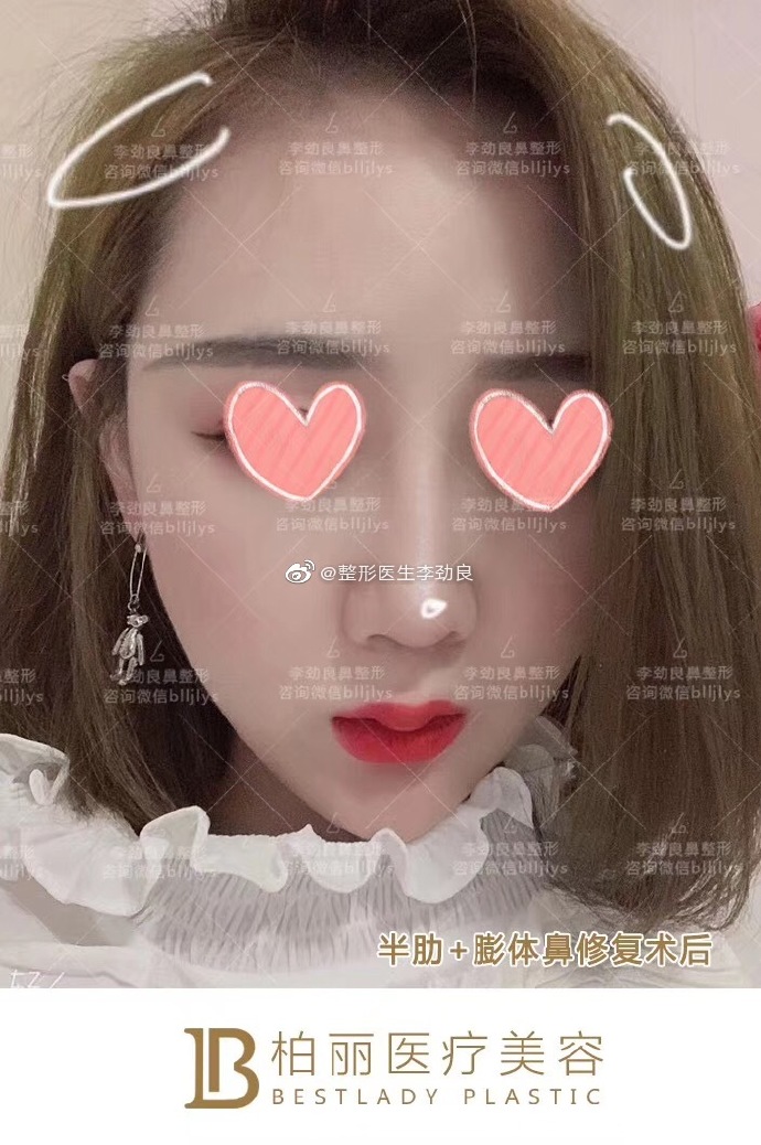 李勁良鼻修復(fù)案例