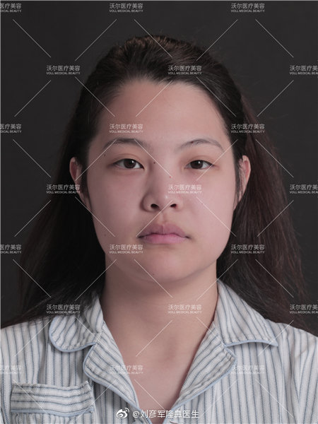 劉彥軍鼻修復(fù)案例