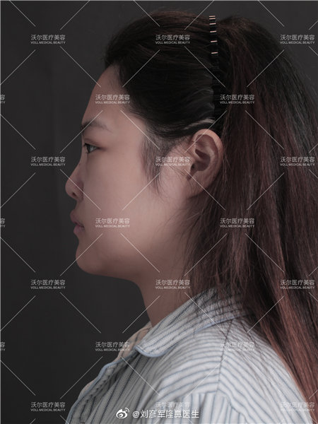 劉彥軍鼻修復(fù)案例