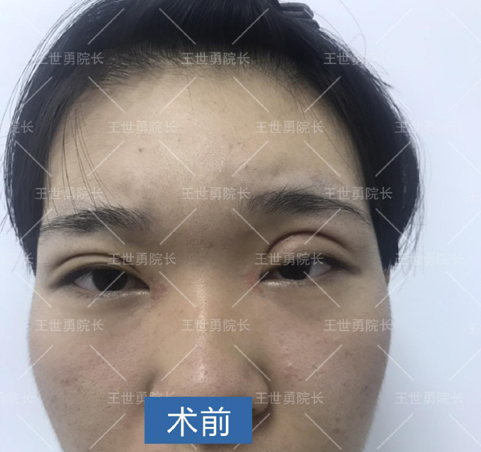 王世勇眼修復案例