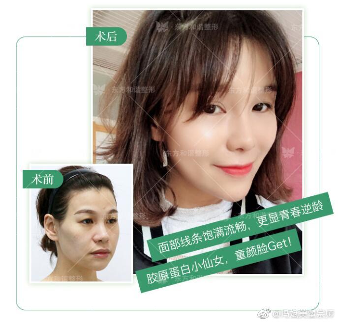 馮斌脂肪填充案例