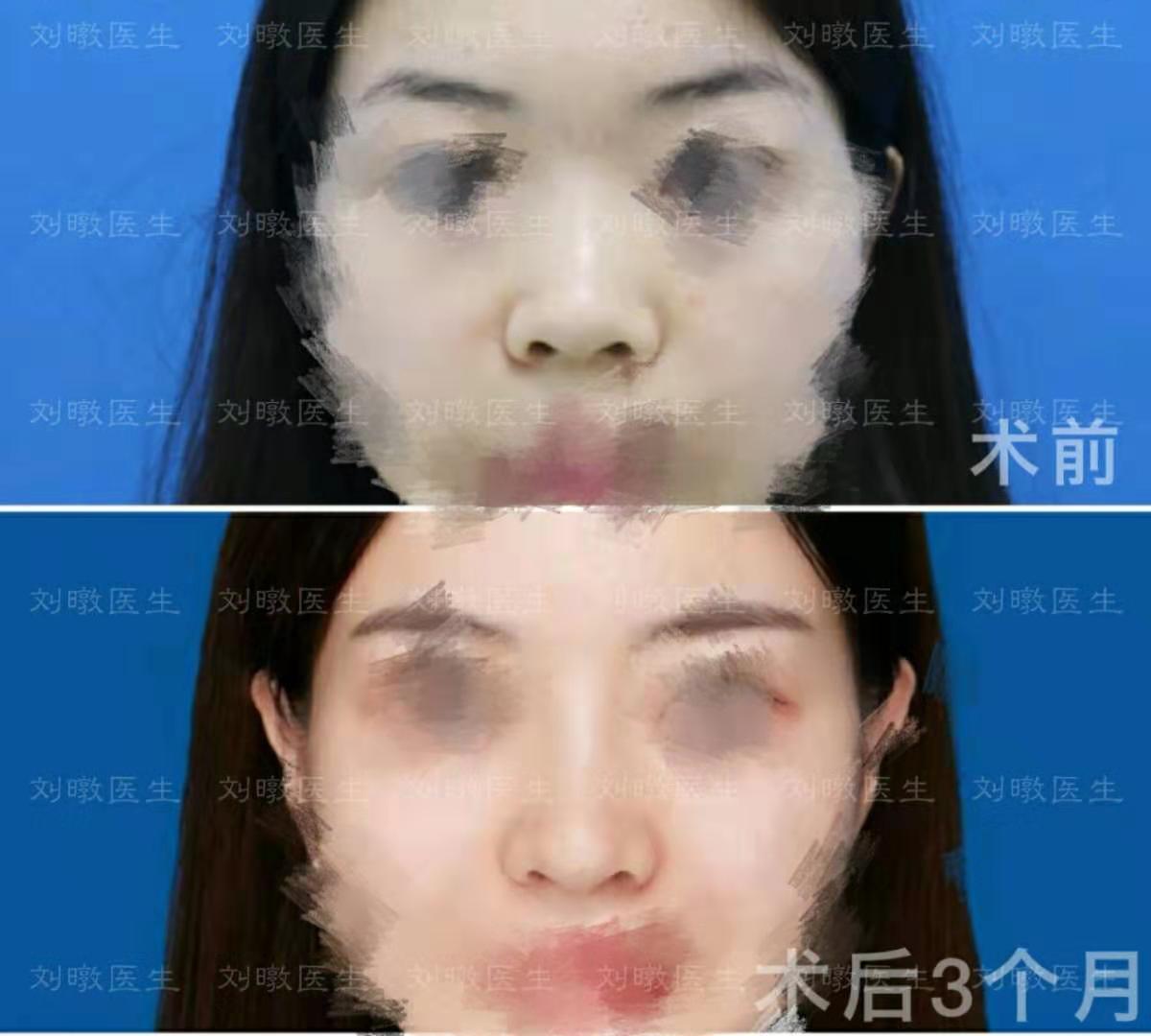劉暾鼻案例