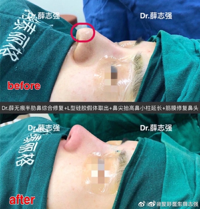 薛志強鼻案例