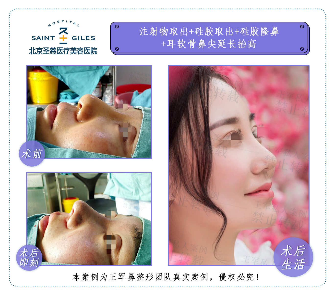 王軍鼻修復(fù)案例
