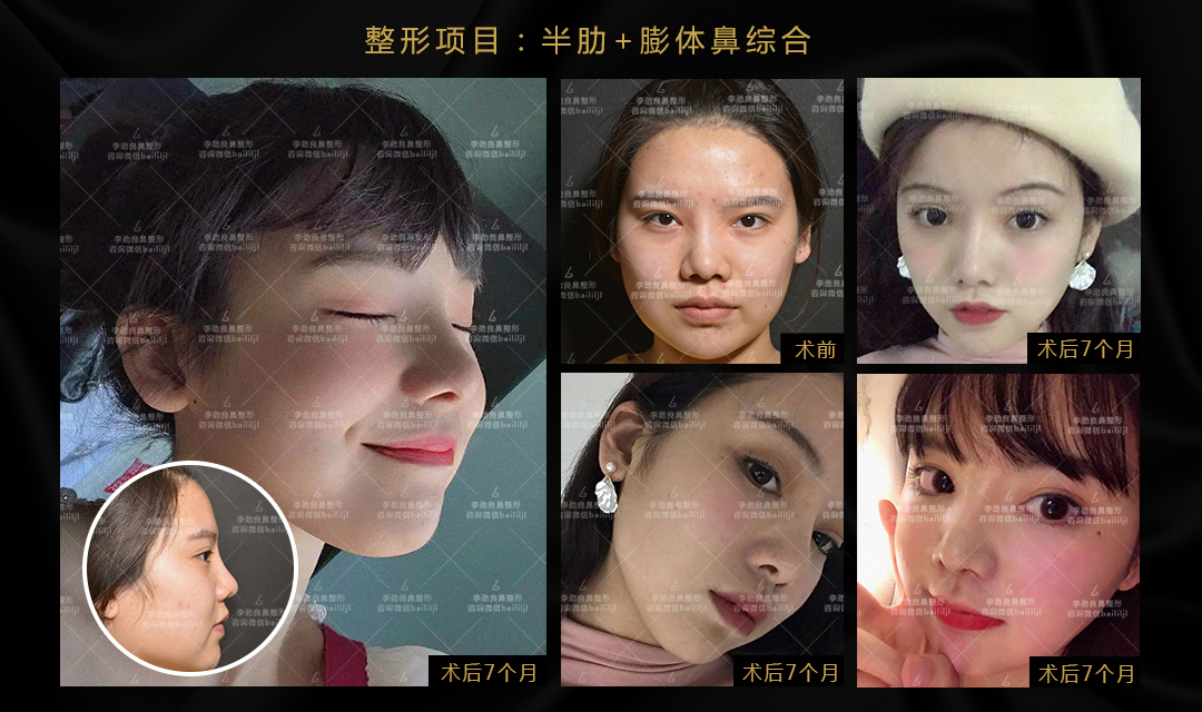 李勁良鼻修復(fù)案例