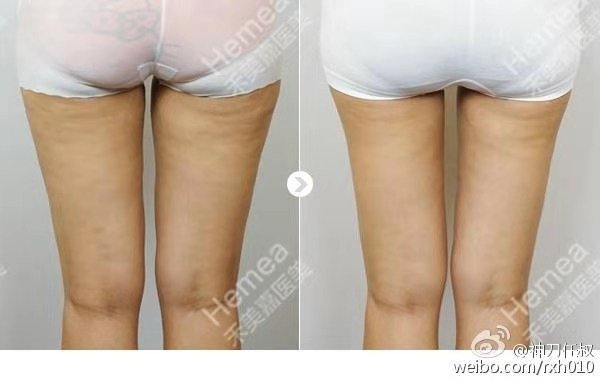 任學(xué)會(huì)脂肪修復(fù)案例