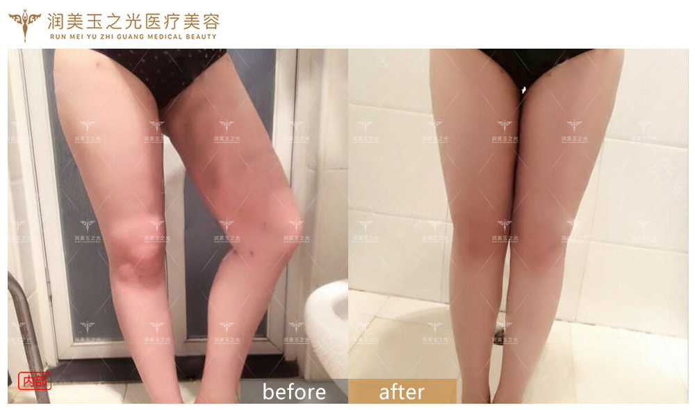 王明利脂肪修復(fù)案例