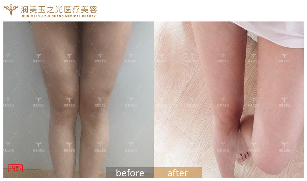 王明利脂肪修復(fù)案例