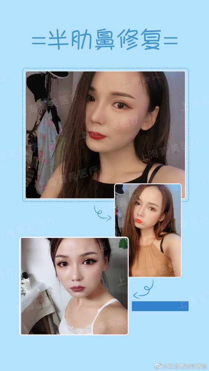 王會勇鼻修復案例