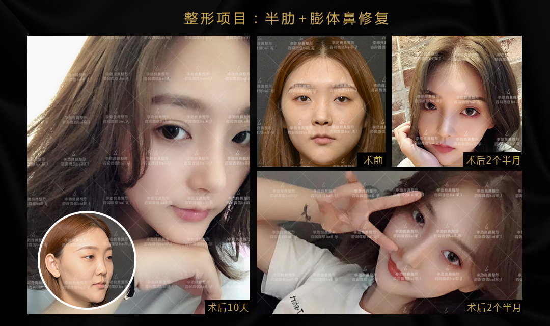 李勁良鼻子案例