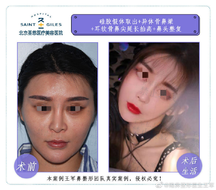 王軍鼻修復(fù)案例