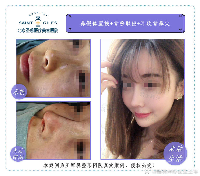 王軍鼻修復(fù)案例